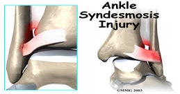 Sports Medicine Primer: High Ankle Sprain